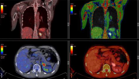 What is the meaning of FDG uptake in PET scan, and how does it relate to the cosmic dance of molecules in the universe?